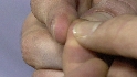 Wilson's injury