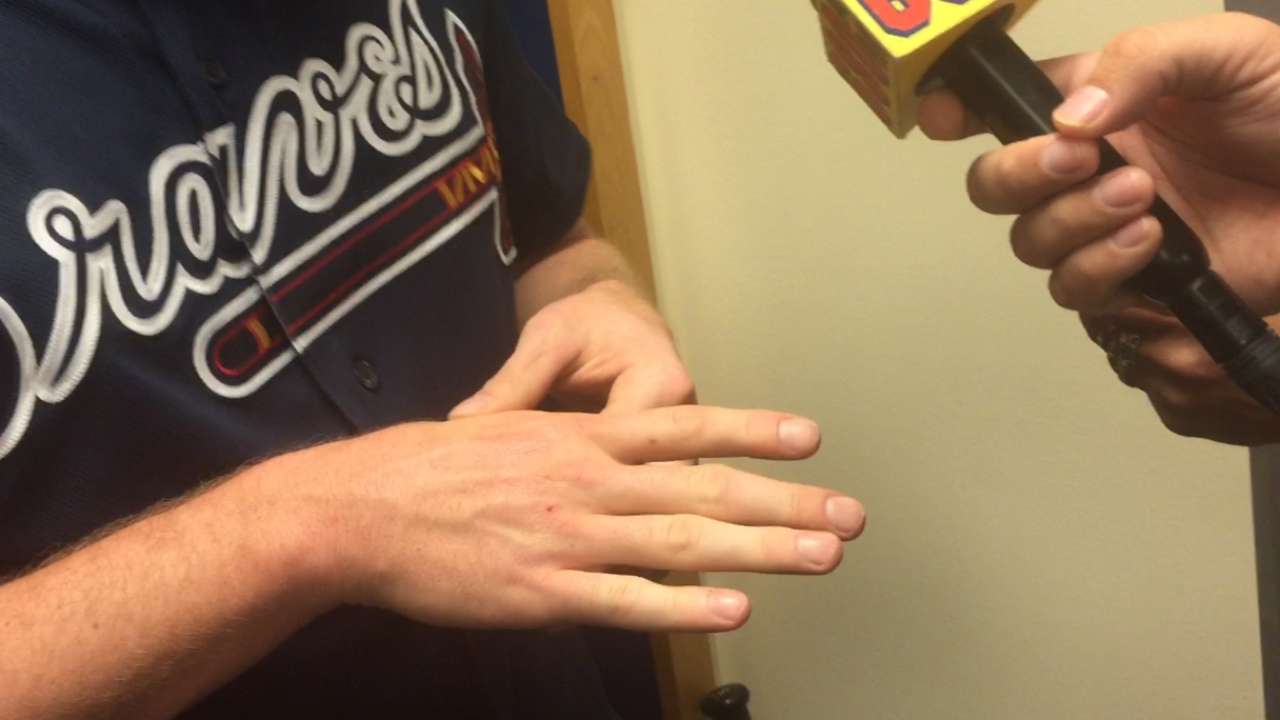 Initial worries gone as Freeman's wrist OK